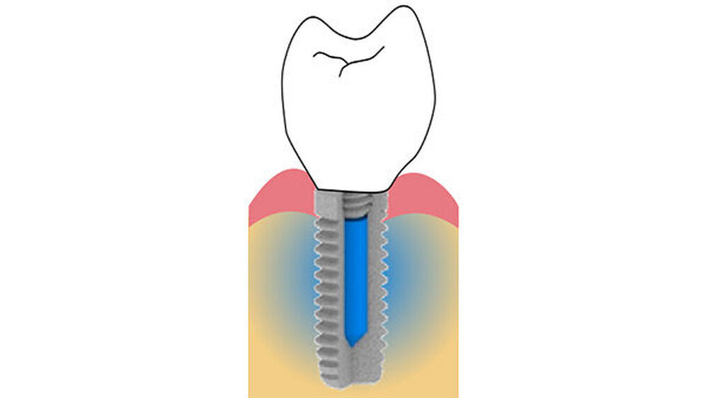Hier ist das Implantat als Schema nach der Osseointegration dargestellt. Ein poröses Kompositmaterial sorgt dafür, dass das Chlorhexidin kontinuierlich in den umliegenden Knochen diffundiert.