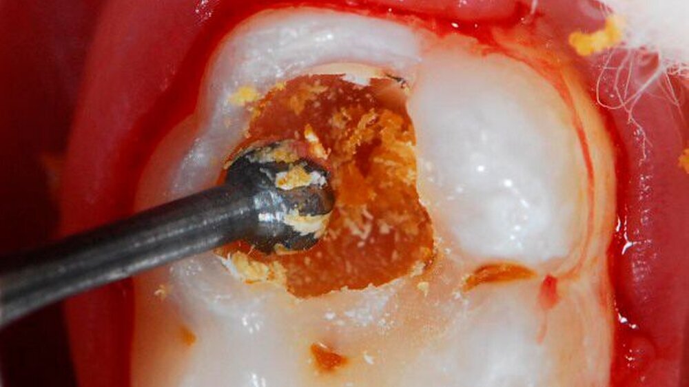 Selektive Kariesexkavation am Milchmolaren 85: Im ersten therapeutischen Schritt wird in der Peripherie beginnend erweichtes, kariöses Dentin entfernt.