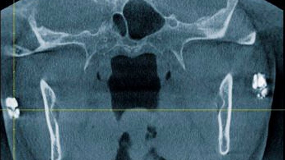 Abbildung 4: DVT-Ansicht in koronaler Richtung |