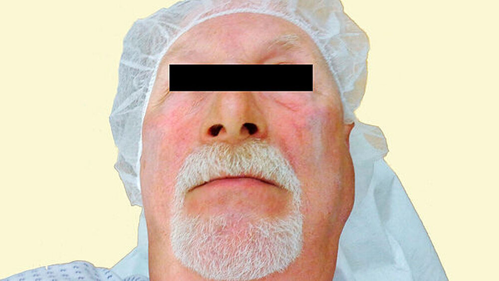 Abbildung 1: Patient mit präaurikulärer Schwellung links |