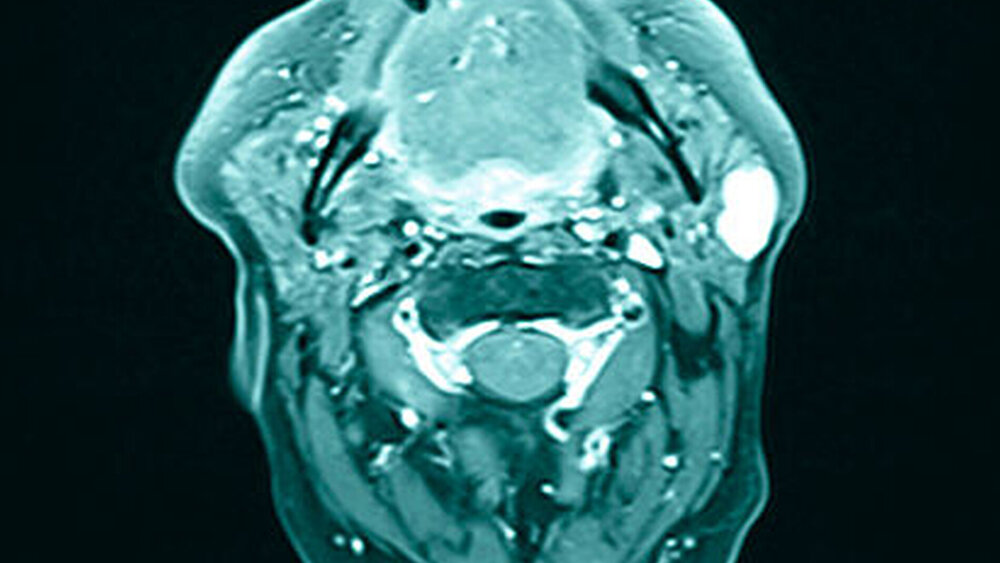 Abbildung 3: Raumforderung im Bereich der linken Parotis im axialen, T1-gewichteten MRT-Bild mit Fettsättigung und Kontrastmittel |