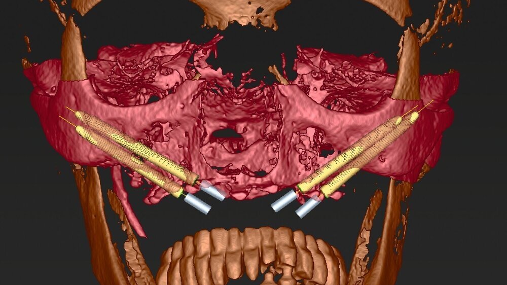 Abb. 7: Planung der Insertion von vier Zygoma-Implantaten im „Quad-Ansatz“