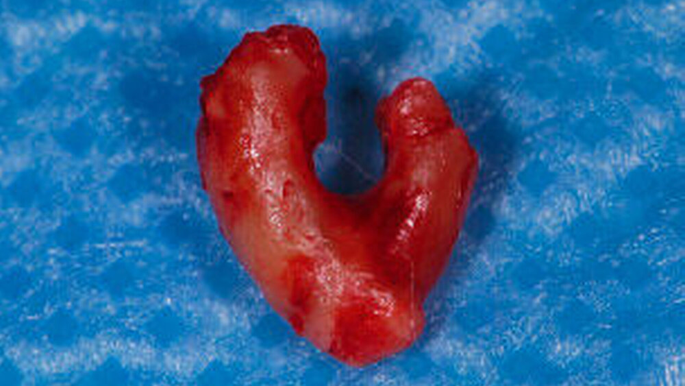 Abbildung 5: Im anatomischen Präparat kann man gut die caudal fusionierte Wurzelspitze erkennen. Der Nerv verlief zwischen den Wurzeln des Zahnes 48 hindurch. |