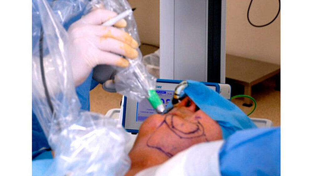 Berührungslose präoperative Desinfektion der Tumoroberfläche mit kaltem physikalischem Plasma (CAP) vor Operation eines Tumors, der mit multiresistenten Keimen besiedelt ist.