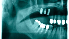 Abbildung 1: Patientenfall mit Freiendsituation im ersten. Quadranten: Der Patient entschied sich nach Abwägen der Vor- und Nachteile für drei Implantate in Regio 14, 15 und 16 mit simultan durchgeführtem Sinuslift. |