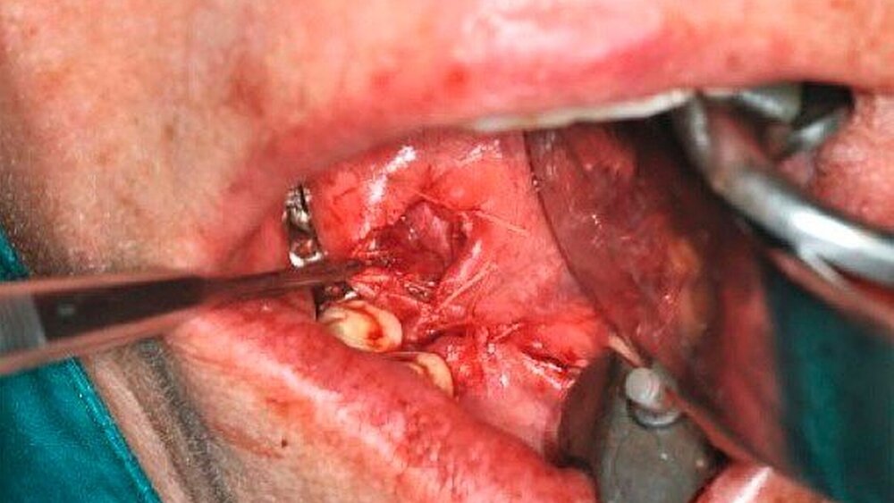 Abbildung 5: Klinisches Bild der intraoperativen Situation nach Bergung des Speichelsteins rechts vor Steppung des Ausführungsgangs an den Mundboden |