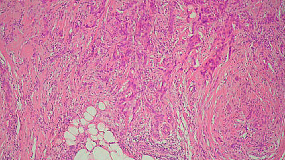 Abbildung 6: Parotisgewebe mit Infiltrationen eines gering differenzierten, maligen, epithelialen Tumors (HE 40x). |