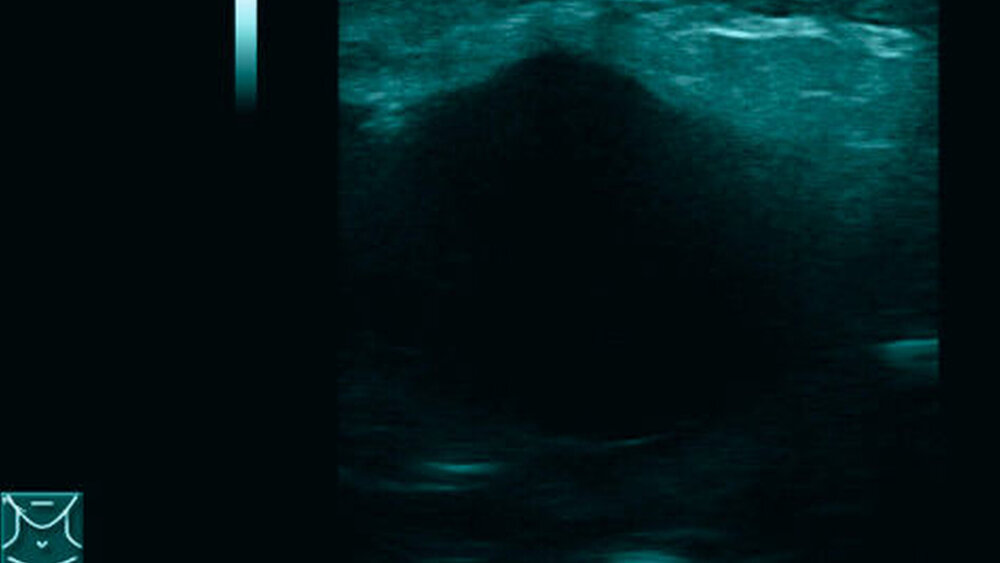 Abbildung 2: Präoperative B-Mode-Sonografie: Sonografisch zeigte sich eine gut abgrenzbare, teils höckerig begrenzte Raumforderung in der Parotis rechts, mit homogenem Binnenecho und ausgedehnter dorsaler Schallverstärkung. |