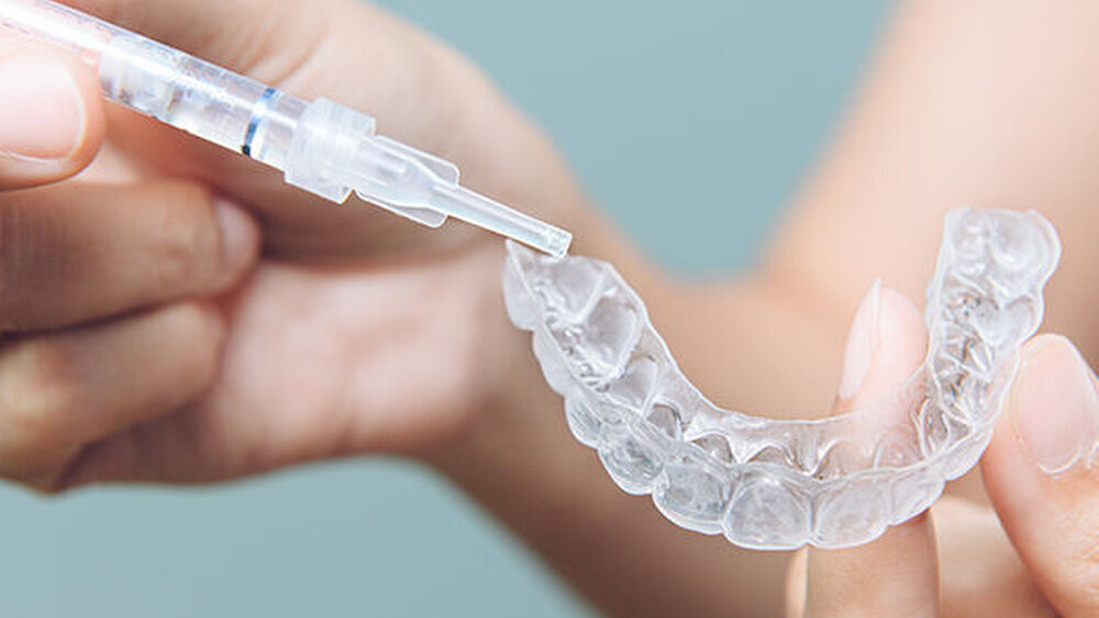 Eine In-vitro-Studie der Universität Toronto veranschaulicht die umfangreichen Schäden, die durch Do-it-yourself-Bleaching enstehen können.