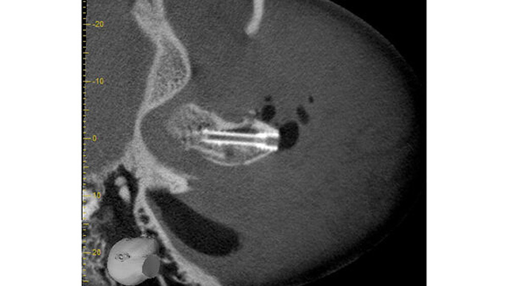 Abbildung 5: Das postoperative DVT zeigt auch die gute Platzierung der Schraube in der axialen Ebene.