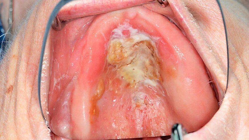 Ältere Patienten haben während einer Mahlzeit einen geringeren „Selbstreinigungseffekt“, das heißt, sie schlucken weniger des Biofilms während einer Mahlzeit. Daher sollten auch die zahnlosen Abschnitte der Mundhöhle gereinigt und massiert werden Ältere Patienten haben während einer Mahlzeit einen geringeren „Selbstreinigungseffekt“, das heißt, sie schlucken weniger des Biofilms während einer Mahlzeit. Daher sollten auch die zahnlosen Abschnitte der Mundhöhle gereinigt und massiert werden.