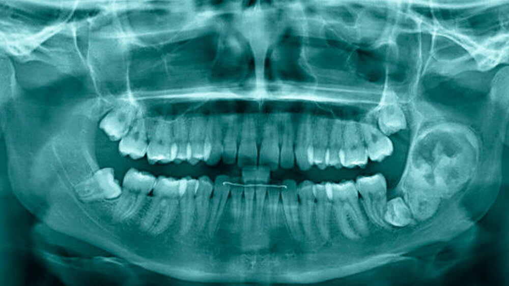 Alio Ioco angefertigte Panoramaschichtaufnahme mit einer knapp 3cm x 5cm großen, radioopaken Raumforderung mit vor allem cranial gelegenen transluzenten Anteilen und einem feinen transluzenten Randsaum, nebenbefundlich retinierte Sapientes |