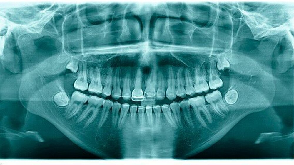 c: Befund dreieinhalb Jahre nach autoTX 15 nach 11: Es zeigt sich im Röntgenbild eine Wurzelobliteration des Transplantats in regio 11, was als vitales Zeichen betrachtet werden kann. Die kieferorthopädische Bewegung des Zahnes ist inzwischen abgeschlossen, es findet sich ein leichter Gewebeüberschuss an Zahn 11 im Vergleich zum gesunden Nachbarzahn 21. Die Zahnkrone am Transplantat 11 wurde zwischenzeitlich in kunststoffadhäsiver Technik aufgebaut. Der kieferorthopädische Lückenschluss im Bereich der Entnahmestelle regio 15 ist erfolgt. |