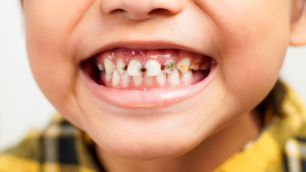 Close-up of a child showing severe tooth decay and plaque on upper teeth