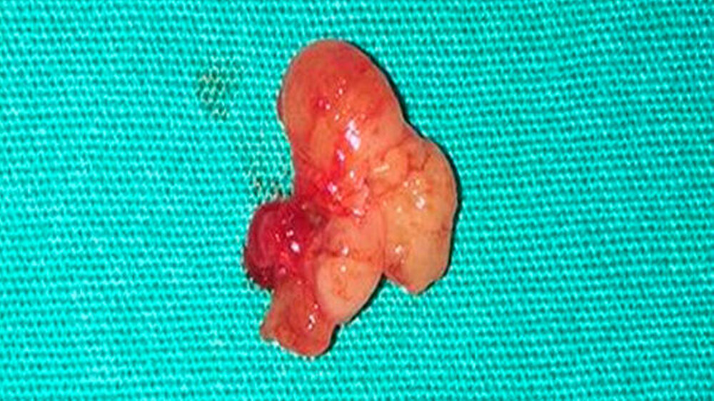 Abbildung 4: Makroskopische Merkmale: gut umschriebene, gelbe Läsion mit 1,5 cm Durchmesser.