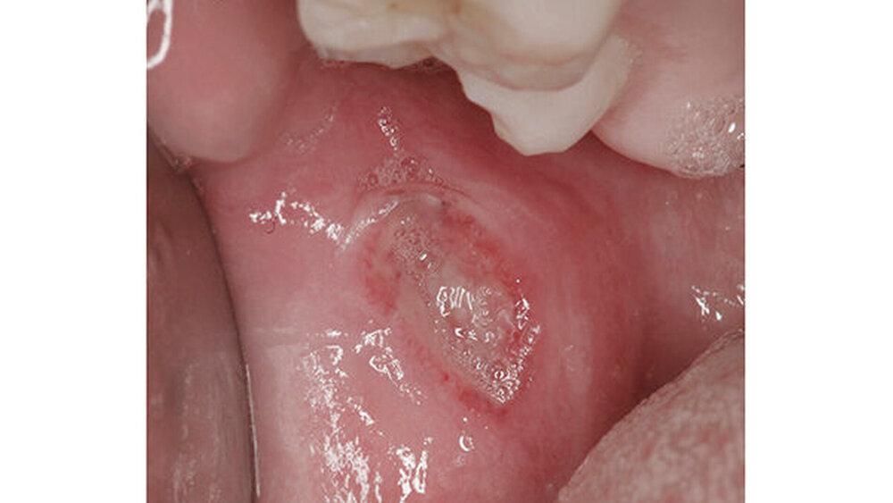 Bei einer erythematösen Candidiasis (hier am Gaumen eines HIV-positiven Patienten ohne antiretrovirale Therapie) oder bei Aphten sollte man immer auch an eine HIV-Infektion denken. |