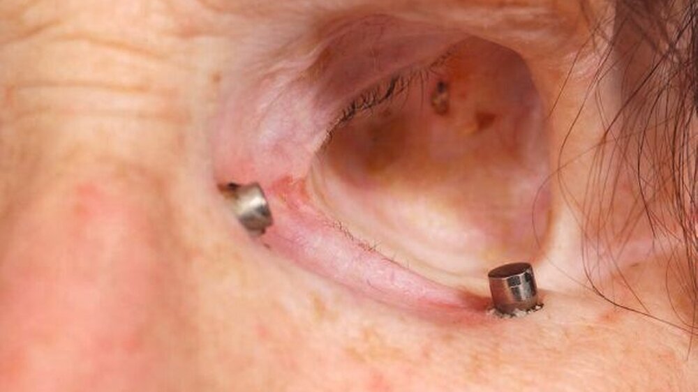 Abbildung 1a: extraorale Implantate zur Fixierung einer Epithese zum Ersatz eines Auges