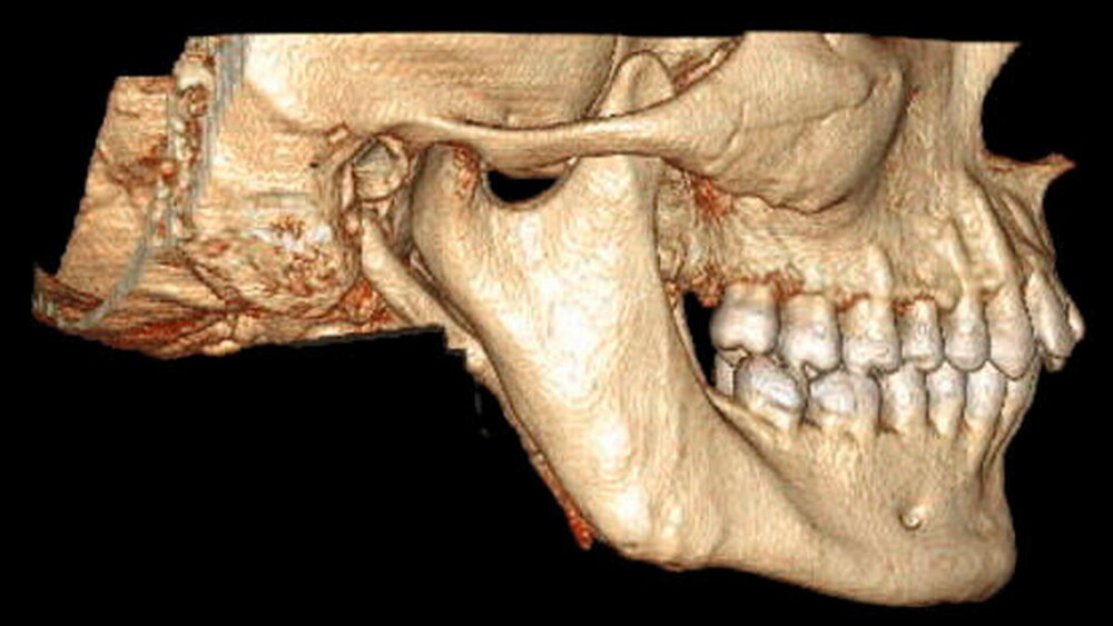 Abbildung 3A und 3B:\r\nComputertomografie, 3-D-Rekonstruktion mit Darstellung der Hyperplasie der Proc. coronoidei rechts (A) und links (B) |