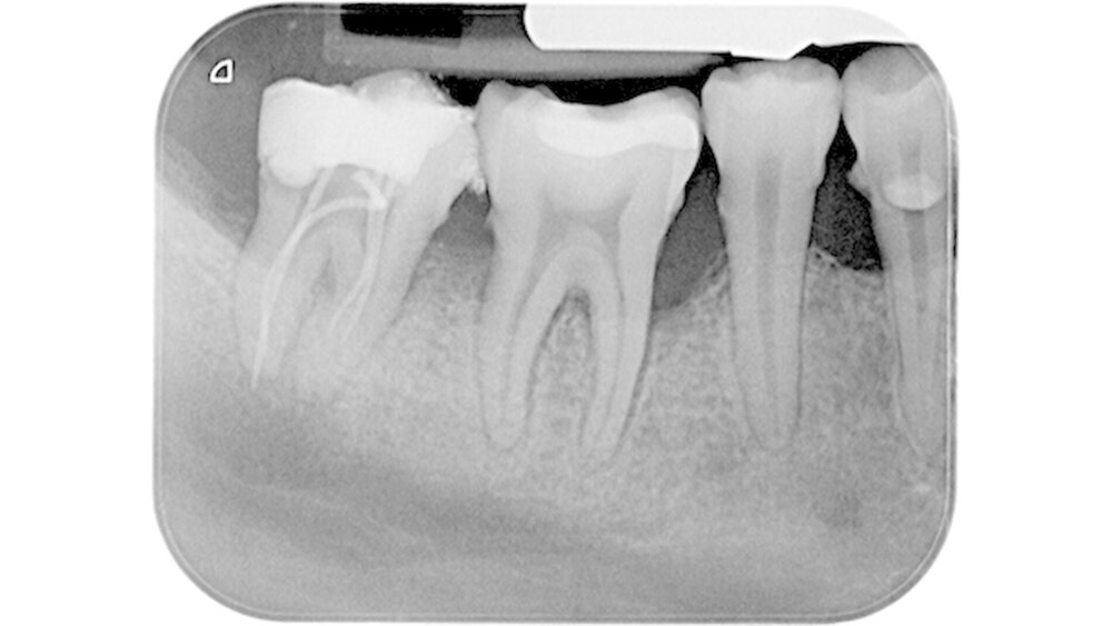 Abbildung 1: Messaufnahme an Zahn 47 nach Beginn einer Wurzelkanalbehandlung im Studentenkurs |