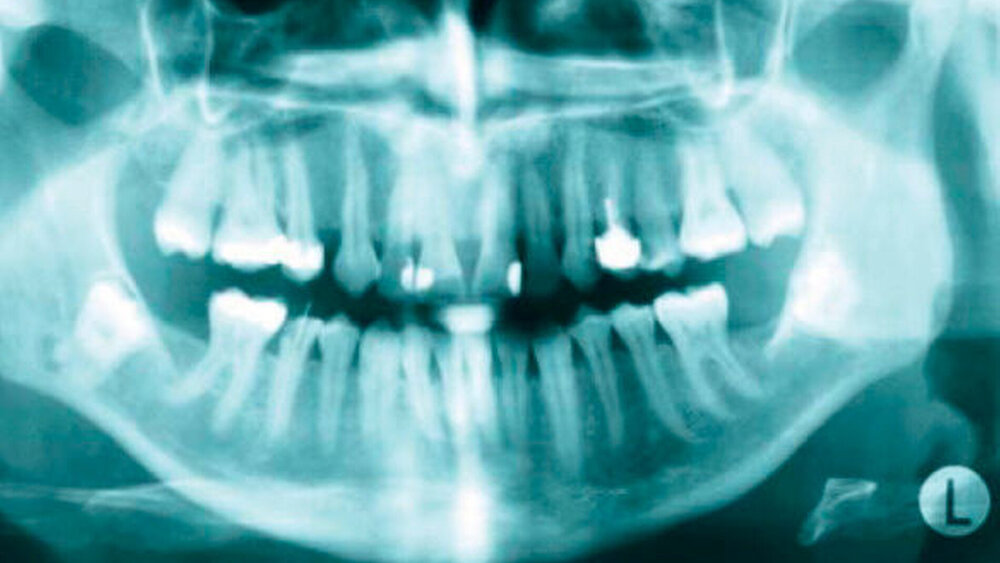 Abbildung 1: Alio loco angefertigte Panoramaschichtaufnahme mit retinierten Zähnen 38 und 48, einem konservativ nicht mehr zu versorgendem Zahn 45 und einer Osteom ähnlichen Struktur im Unterkiefer links zwischen den Zähnen 34 und 35 |
