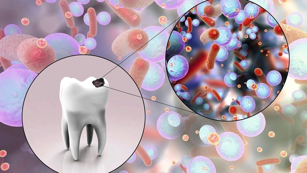 Tooth with dental caries Karies
