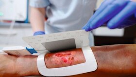 Chronische Wunde mit Plasma-Patch