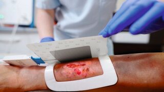 Chronische Wunde mit Plasma-Patch
