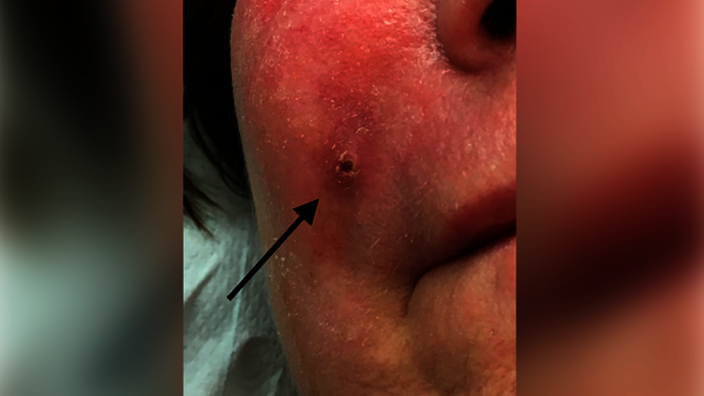 Abb. 1: Klinisches Bild der Patientin: Es zeigt sich eine ausgeprägte harte Schwellung und Rötung der gesamten rechten Wange. Im Bereich der Nasolabialfalte wurde alio loco bereits zweimalig vorinzidiert (schwarzer Pfeil).\r\n