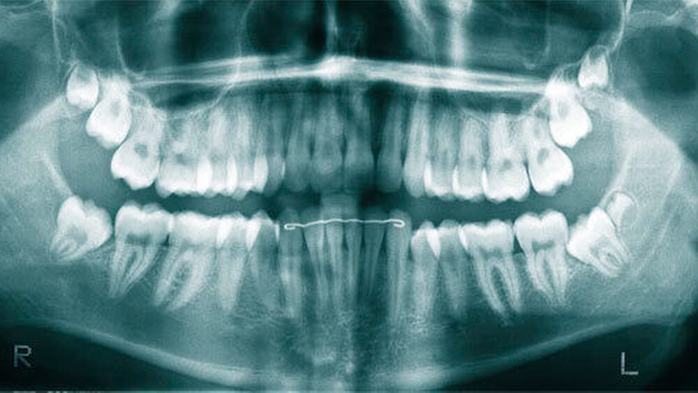Abbildung 8: 17-jähriger Knabe mit überzähligen Distomolaren (sogenannte „9er“) im Oberkiefer beidseits und im Unterkiefer links, welche während einer kieferorthopädischen Therapie zufällig diagnostiziert und zur Entfernung überwiesen wurden. |