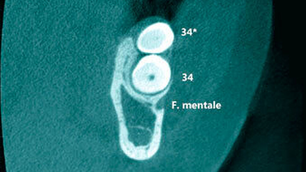 5d: Koronaler Schnitt mit Darstellung der Zahnkronen 34, 34+ und des Foramen mentale. |