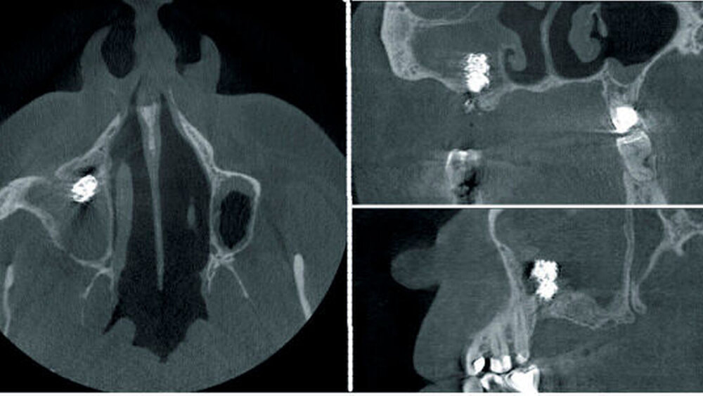 Abbildung 8: In die rechte Kieferhöhle disloziertes feinkörniges Augmentationsmaterial mit konsekutiver Sinusitis maxillaris: Nebenbefundlich auffällig ist die beidseitige knöcherne Fensterung der Kieferhöhle zur Nase, die auf eine voroperierte Kieferhöhle hinweist. |