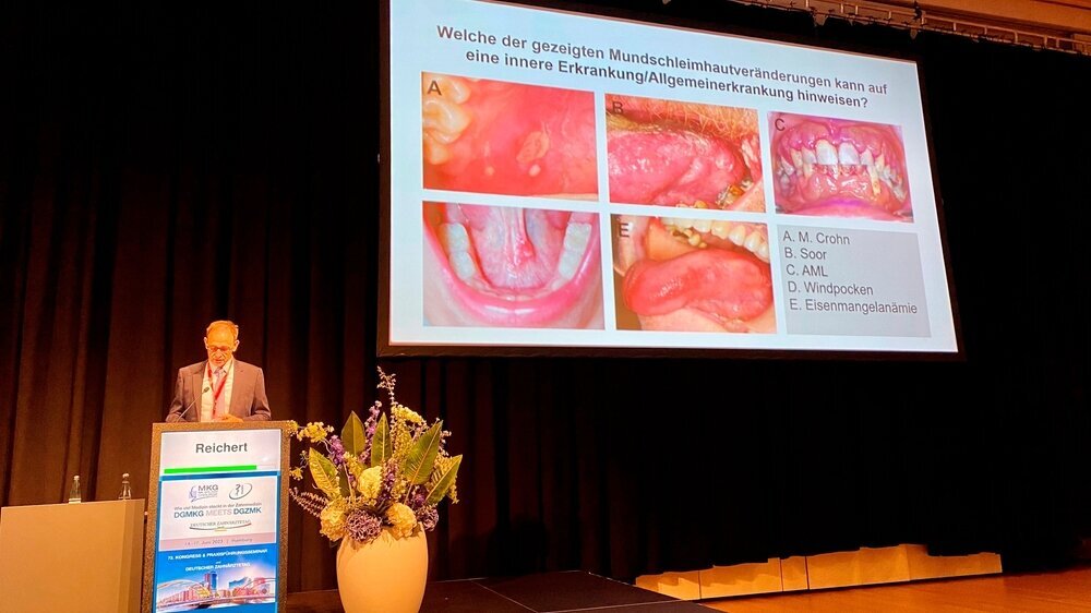 Prof. Dr. Dr. Torsten Reichert (Regensburg) erklärte in seinem Vortrag „Mundschleimhauterkrankungen – Konsequenzen für Medizin und Zahnmedizin“, dass diese ein Paradebeispiel für die enge Vernetzung des zahnmedizinischen Alltags mit der Medizin sind. Es sei die verantwortungsvolle Aufgabe der Zahnärzteschaft, Mundschleimhauterkrankungen als Erste zu erkennen und zu diagnostizieren. Anhand einer praxisrelevanten Einteilung (originäre Veränderungen der Mundschleimhaut mit und ohne Krankheitswert; orale potenziell maligne Veränderungen; Erkrankungen der Haut mit oralen Manifestationen; Mundschleimhautveränderungen bei systemischen Erkrankungen) zeigte Reichert multiple klinische Beispiele. Insbesondere das Spektrum oraler Symptome bei Systemerkrankungen verdeutlicht die herausragende Relevanz der Mundhöhle für die Früherkennung und die Vernetzung von Zahn- und Humanmedizin.