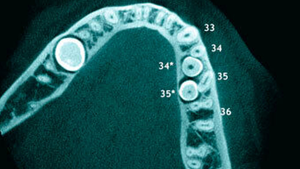 2c: Axiales Schnittbild der linken Mandibula mit 34, 35, 34+ und 35+. |