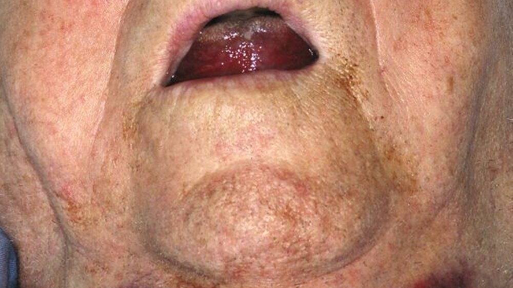 Abbildung 1: 81-jähriger Patient mit ausgeprägtem Mundbodenhämatom und beginnender Atemnot nach Extraktion der Unterkieferfrontzähne: Die weitere Diagnostik erbrachte eine primäre Myelofibrose als Ursache für die Blutgerinnungsstörung. | Abbildung 1: 81-jähriger Patient mit ausgeprägtem Mundbodenhämatom und beginnender Atemnot nach Extraktion der Unterkieferfrontzähne: Die weitere Diagnostik erbrachte eine primäre Myelofibrose als Ursache für die Blutgerinnungsstörung. |