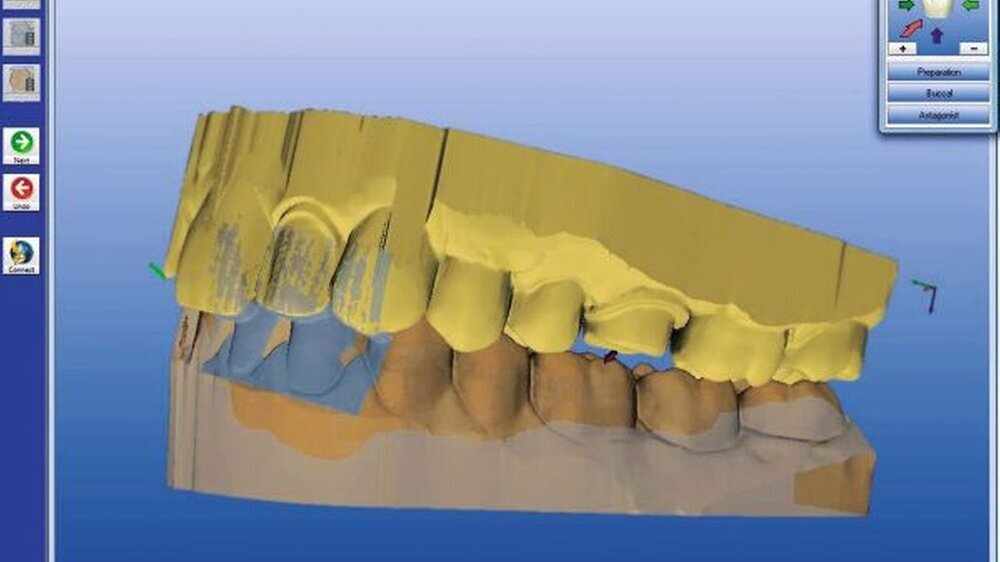 Abbildung 1: Die digitale Intraoral-Abformung mit Gegenbiss ist das künftige Medium zwischen Zahnarztpraxis und ZT-Labor. Der Datensatz ist präziser als ein konventioneller Elastomerabdruck.