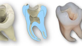 Konstruktion eines Übungszahns (v.l.n.r.): Übersicht des ganzen Zahns bestehend aus Schmelz und Dentin, Querschnitt des Zahns, kompletter im 3-D-Druckverfahren hergestellter Zahn