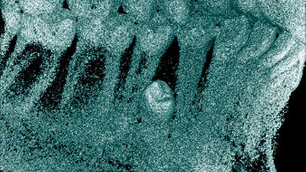Abbildung 11: Überzähliger Zahn im Prämolarenbereich des linken Unterkiefers (34+) mit identischer Zahnform bei einem 23-jährigen Patienten (c: 3-dimensionale Bildrekonstruktion). |