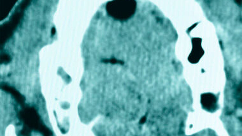 Abbildung 2: Computertomografie in der sagittalen (2a) und in der axialen (2b) Ansicht: Es imponiert eine leicht inhomogene Raumforderung mit einem hypodensen intraläsionalen Saum ohne infiltratives Wachstumsmuster. |