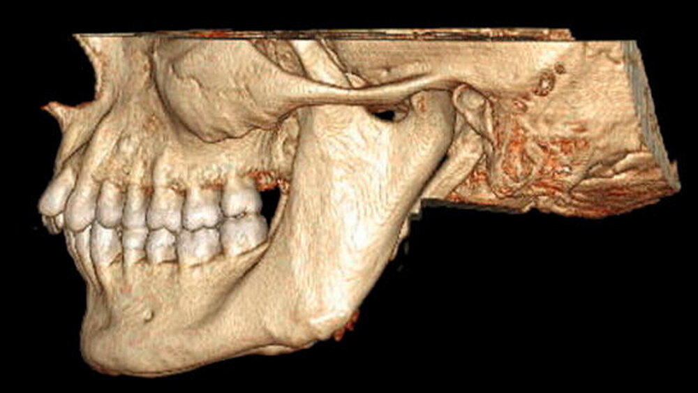 Abbildung 3A und 3B: Computertomografie, 3-D-Rekonstruktion mit Darstellung der Hyperplasie der Proc. coronoidei rechts (A) und links (B) |