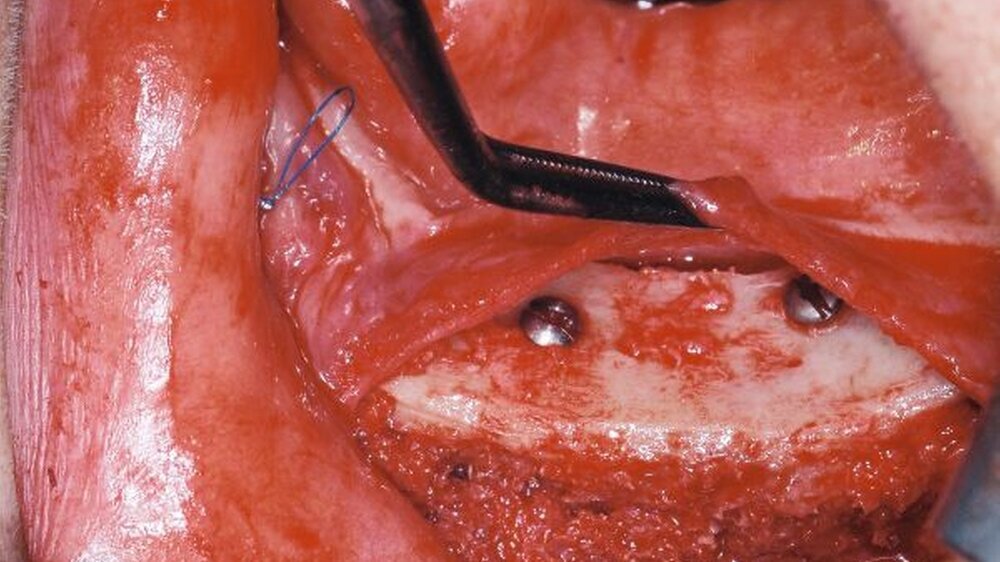 Klinisches Beispiel für die Schwierigkeit bei der Deckung von umfangreichen Alveolarkammaugmentationen