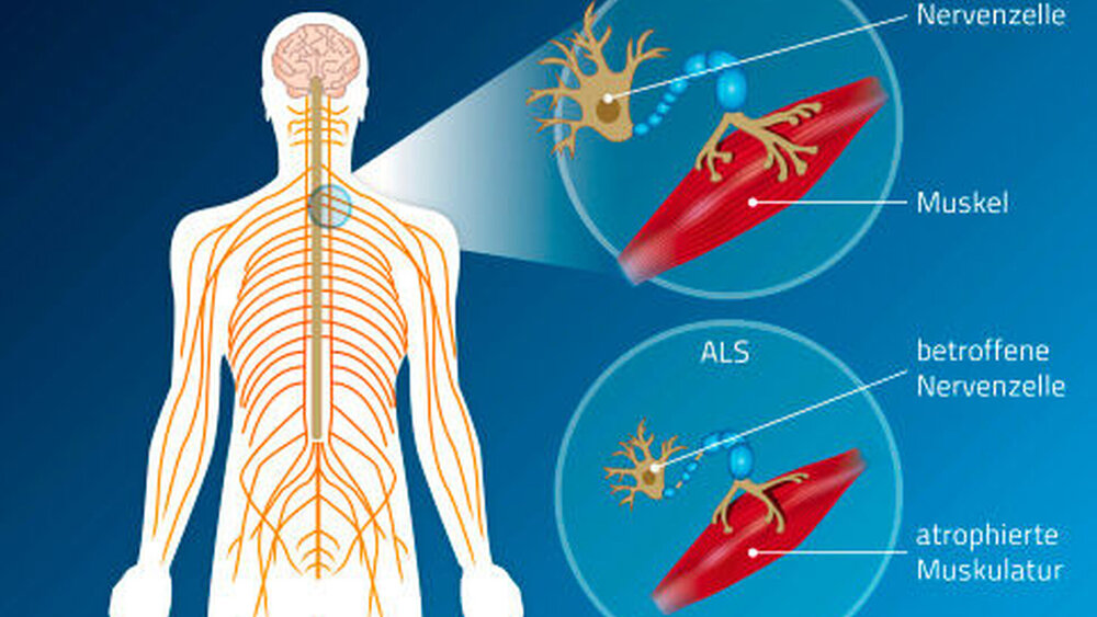 Bei der amyotrophen Lateralsklerose handelt es sich um eine neuromuskuläre Erkrankung mit einer Degeneration von Nervenzellen. |