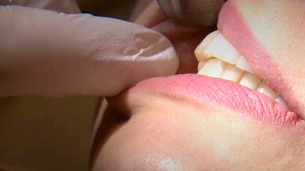 Aufgrund zunehmender Schmerzen und Schwierigkeiten beim Essen brach Patientin Celine ihre Behandlung beim Aligner-Anbieter DrSmile ab, berichtete der NDR. Anschließend begab sie sich in Behandlung bei der niedergelassenen Kieferorthopädin Dr. Luzie Brau