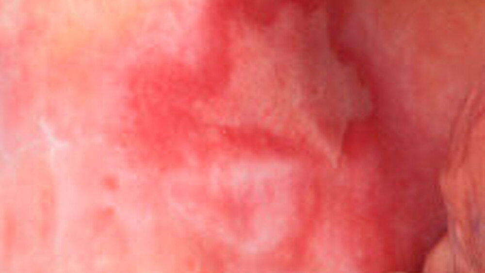 Abbildung 5: Oraler Lichen planus (erosiv, zum Teil retikulär, symptomatisch) |