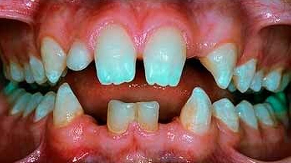 Jugendliche Patientin mit Oligodontie: Im Frontzahnbereich imponieren hypoplastische Eckzähne und obere zentrale Inzisivi sowie die persistierenden Milchzähne 52, 71 und 81.