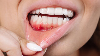 Symbolbild Parodontitis