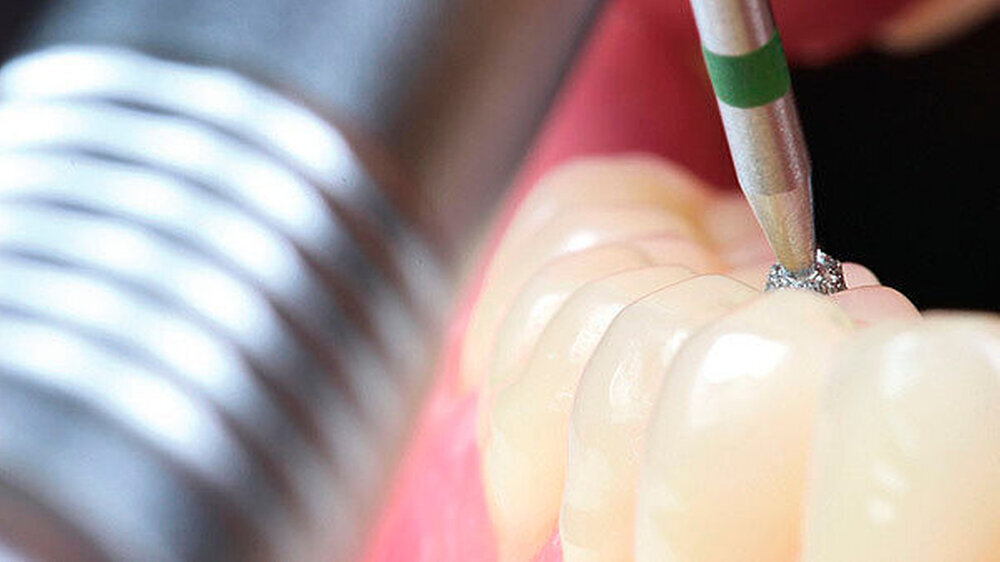 Der Kompromiss sieht so aus, dass die pauschale Höherstufung aller dentalen Produkte, die Nanomaterialien enthalten beziehungsweise freisetzen können, in die höchste Risikoklasse modifiziert wurde. Die genaue Definition des Expositionsrisikos steht all Der Kompromiss sieht so aus, dass die pauschale Höherstufung aller dentalen Produkte, die Nanomaterialien enthalten beziehungsweise freisetzen können, in die höchste Risikoklasse modifiziert wurde. Die genaue Definition des Expositionsrisikos steht allerdings noch aus.