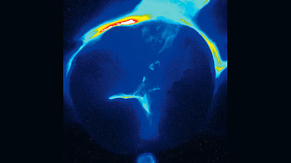 Die Abbildung links zeigt die Biolumineszenzaufnahme einer aktiven Läsion mit einer neueren Calcivis-Kamera. In der Mitte die visuelle Ansicht eines Molaren mit aktiver Läsion okklusal, rechts im Lumineszenzmodus.