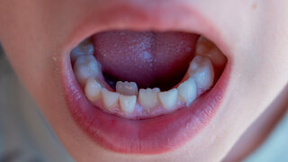 Mund mit Milchzähnen: Zahndurchbruch der bleibenden Zähne bei einem Kind.