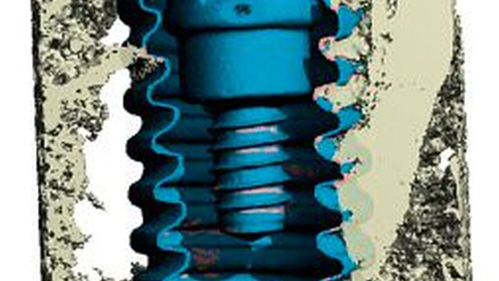 Abbildung 3: Darstellung der Ersatzresorption und Dentointegration eines Straumann Bone Level Implantates im Micro CT. |