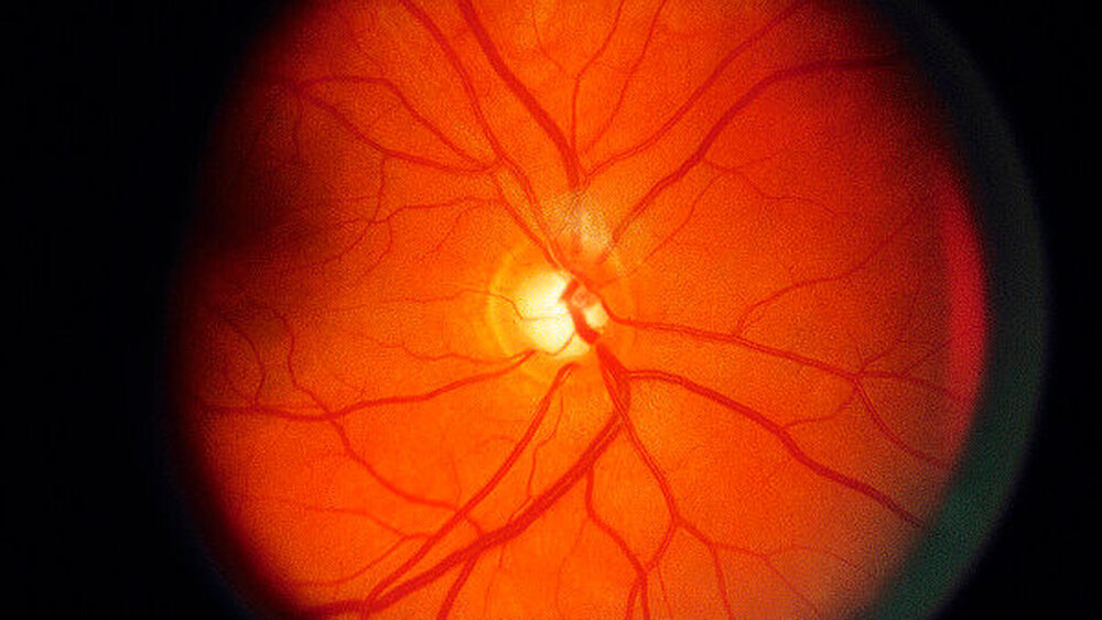 Erst mit einer Augenhintergrund-Spiegelung kann man ein Glaukom sicher diagnostizieren. Daher raten Augenärzte diese Untersuchung ab dem 40. Lebensjahr regelmäßig durchführen zu lassen. |